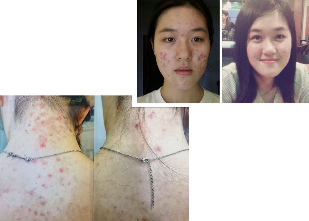 Testimonial for Acne | Negative Ions Clothes