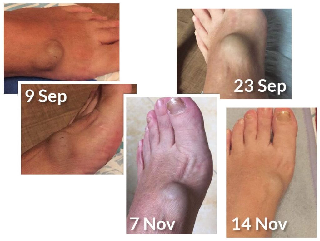 Testimonial for Severe Blood Clot | Negative Ions Clothes