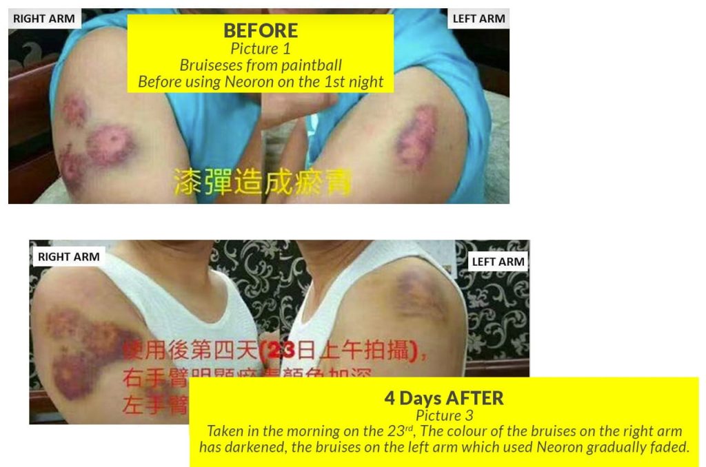 Testimonial for Bruises, Recovery | Negative Ions Clothes