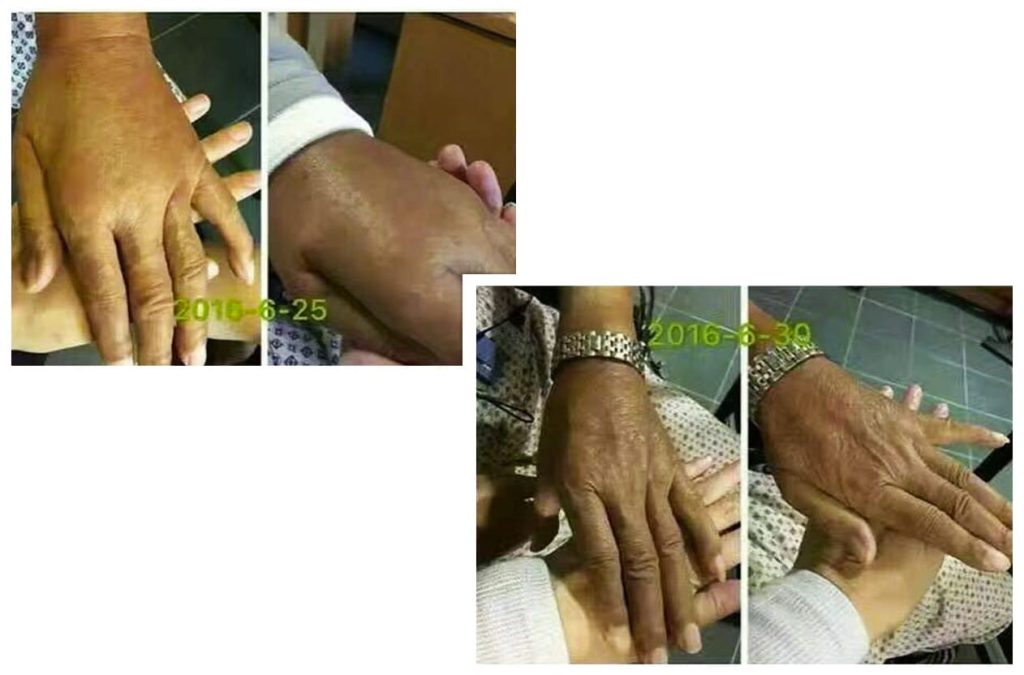 Testimonial for Diabetes, Healing, Swelling from Hong Kong | Negative Ions Clothes