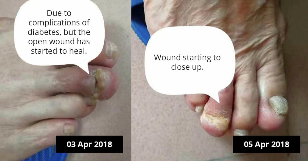 Testimonial for Diabetes - Toes Recover | Negative Ions Clothes