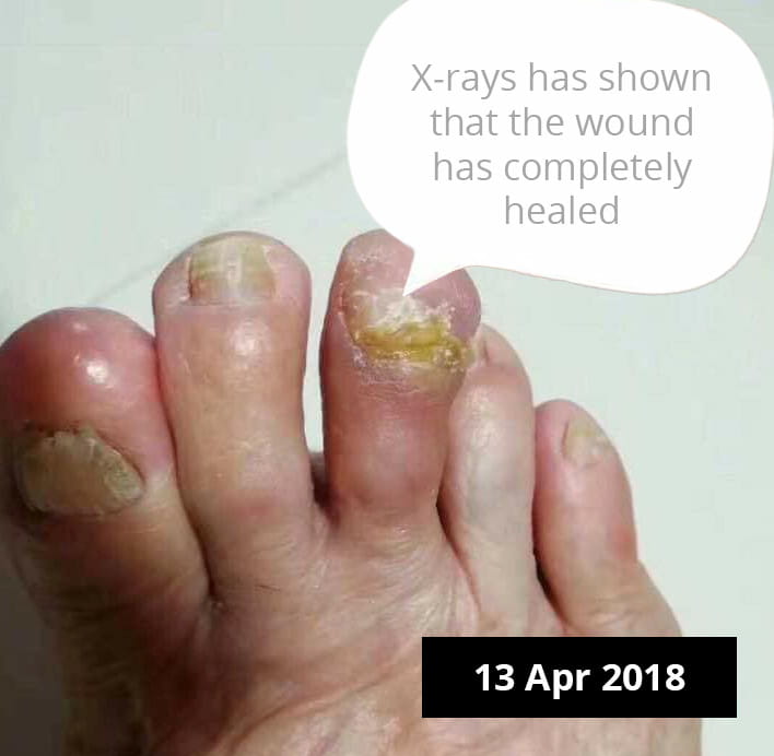 Testimonial for Diabetes - Wound Healing | Negative Ions Clothes