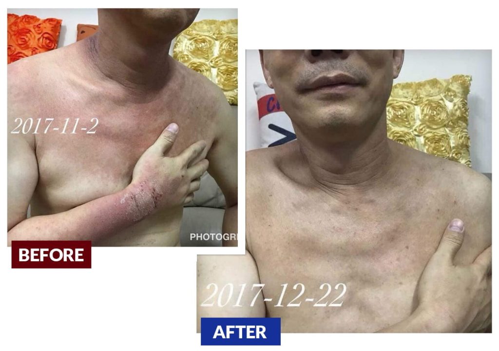 Testimonial for Eczema, Dermatitis, Nasal Congestion, Long Term Headache | Negative Ions Clothes