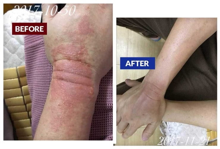 Testimonial for Eczema, Dermatitis, Nasal Congestion, Long Term Headache - Hand | Negative Ions Clothes