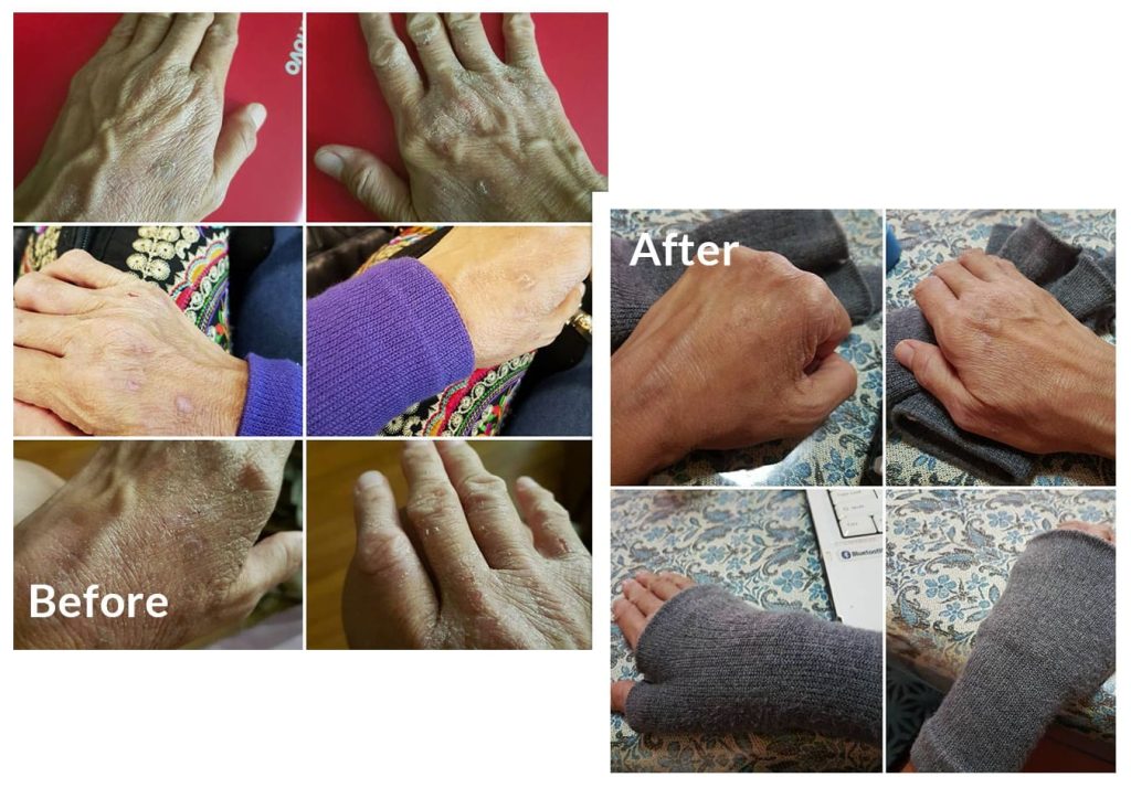 Testimonial for Eczema | Negative Ions Clothes