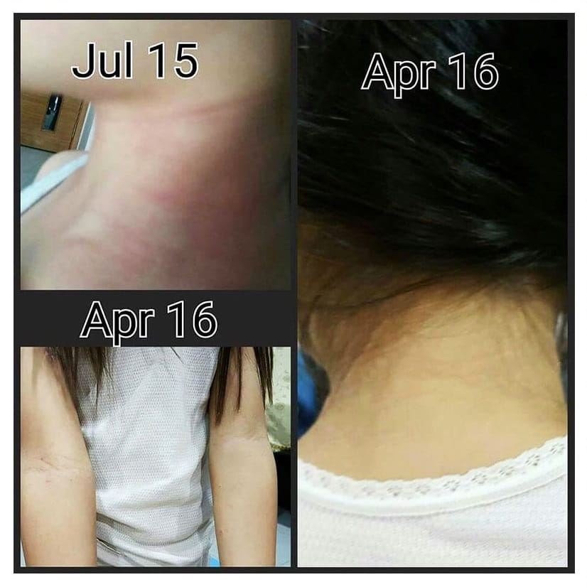 Testimonial for Eczema, Migraine and Stomach Acid | Negative Ions Clothes