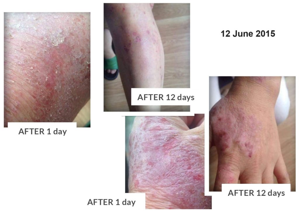 Testimonial for Eczema all Over her Body | Negative Ions Clothes