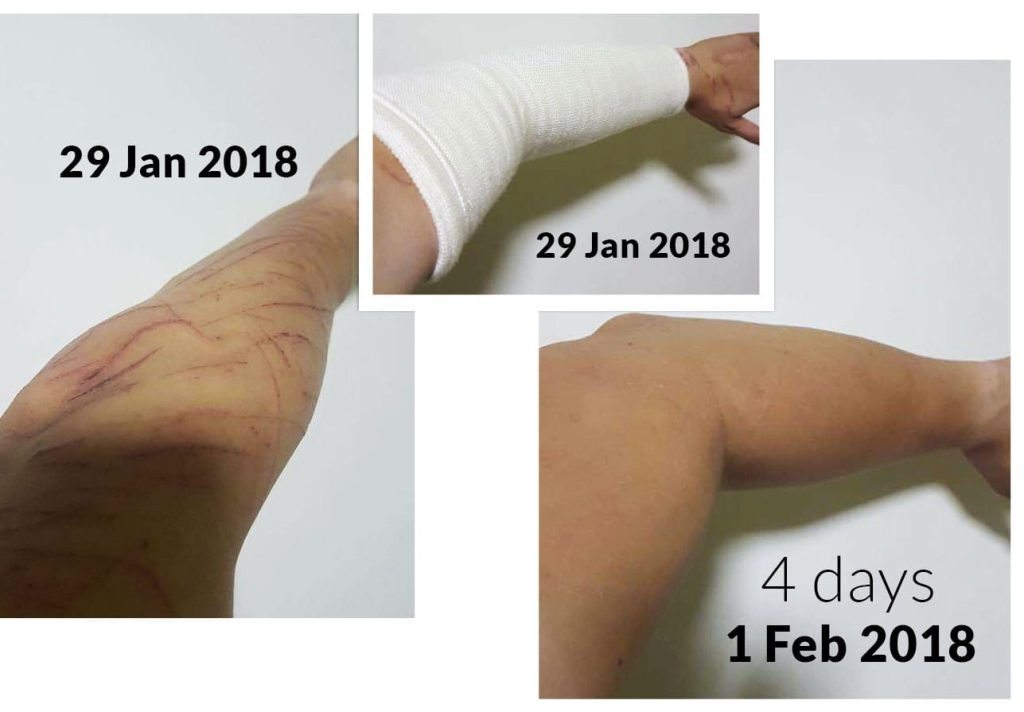 Testimonial for Injury and Scratches from Singapore | Negative Ions Clothes