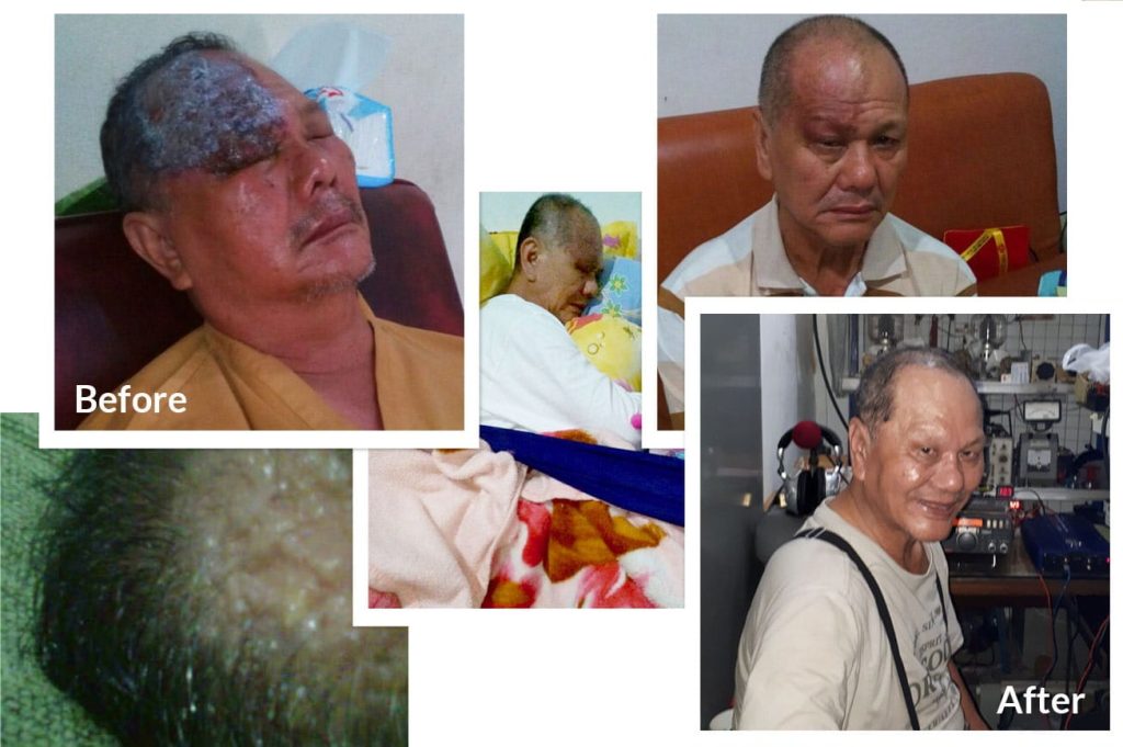 Testimonial for Shingles to Boils and Severe Headache from Bandung, Indonesia | Negative Ions Clothes