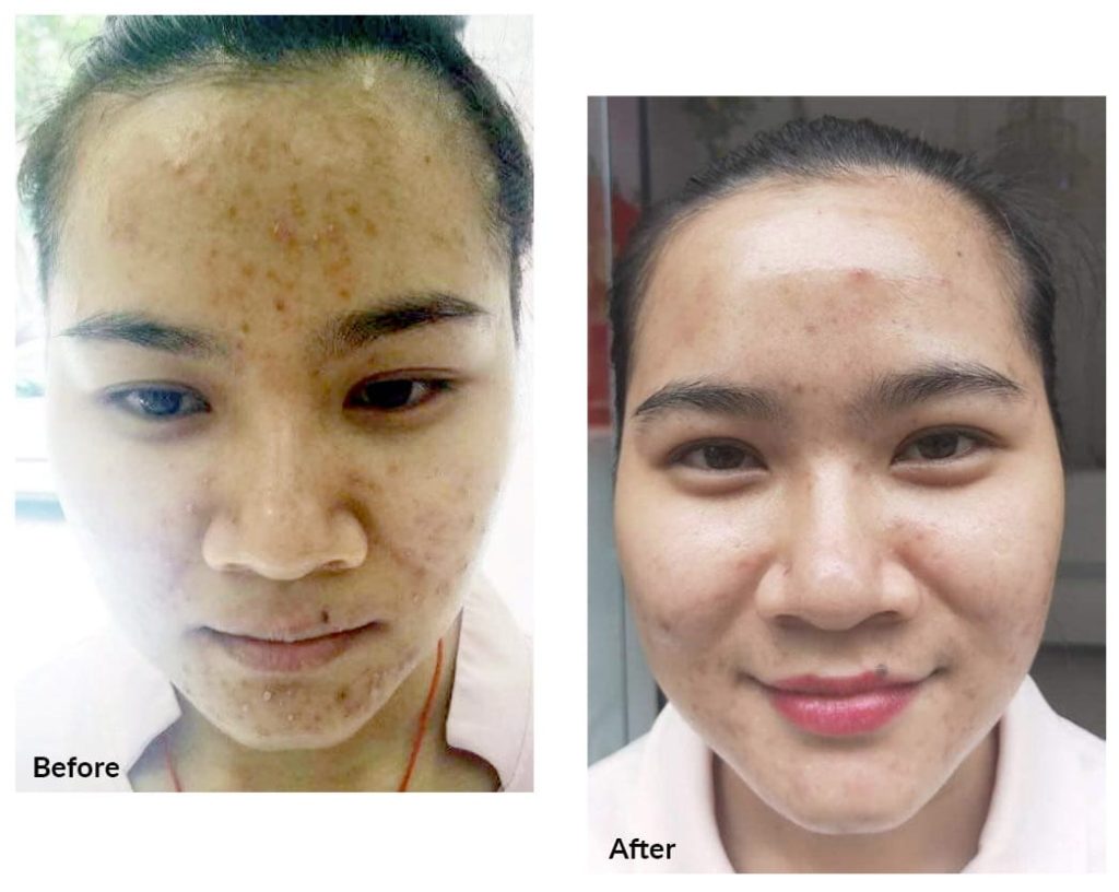 Testimonial for Severe Skin Acne | Negative Ions Clothes