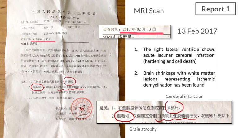 Testimonial for Stroke Cerebralinfarction and Brainatrophy - Report 1 | Negative Ions Clothes