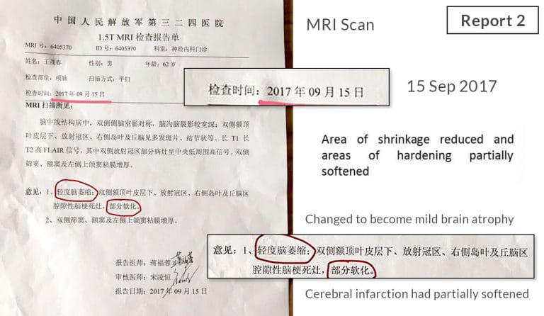 Testimonial for Stroke Cerebralinfarction and Brainatrophy- Report 2 | Negative Ions Clothes