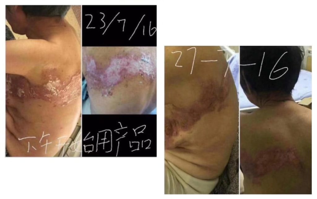 Testimonial for Shingles | Negative Ions Clothes