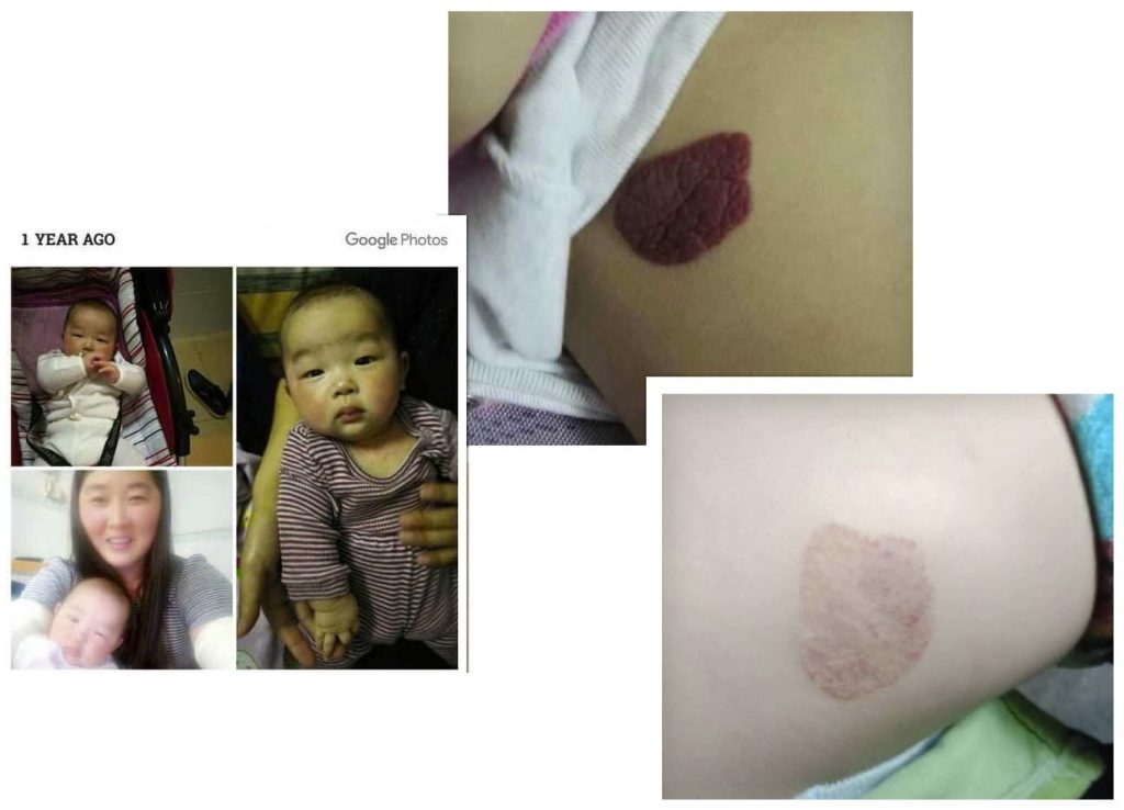 Testimonial for Vascular Tumour | Negative Ions Clothes